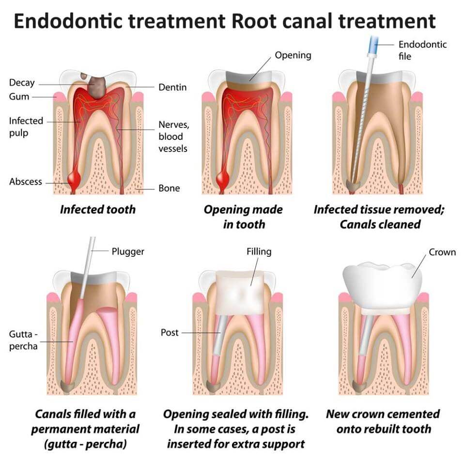 Endodontic-Treatment-Endodonstist-Leicester - Endodontist Leicester for root canal treatment