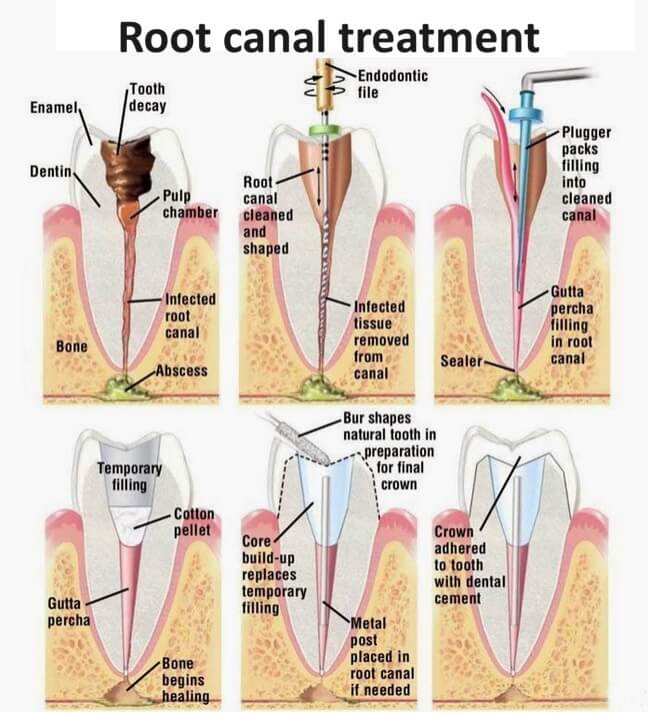 Root-Canal-Treatment-Leicester - Endodontist Leicester for root canal treatment